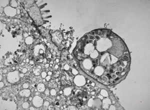 M,33y. | cryptosporidiosis - duodenum, im | munodeficient pacient M,33y. | cryptosporidiosis - duodenum, im | munodeficient pacient